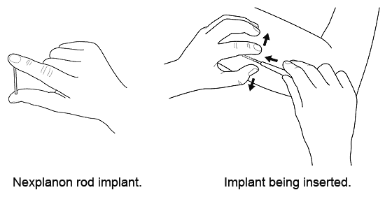 implant